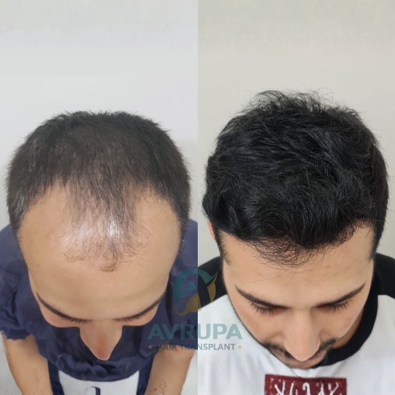 before and after